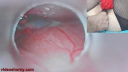【無修正】子宮内の精液と子宮内内視鏡カメラを含浸させる熟女妻 - Insemination Cum into Uterus and Endoscope Camera